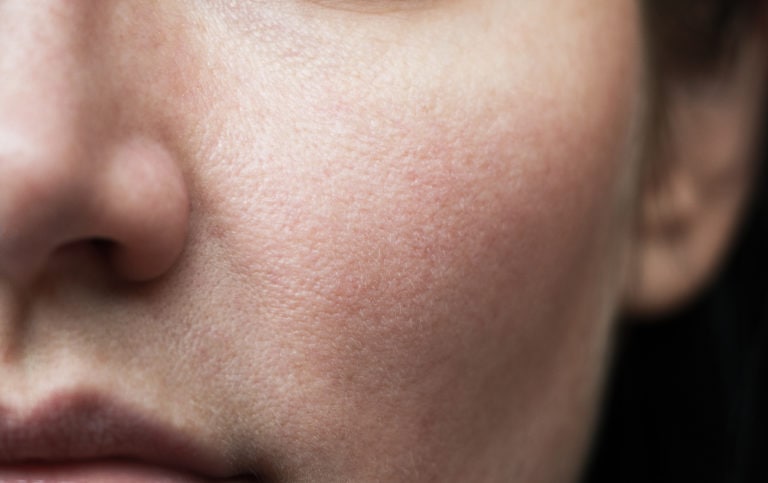 How To Get Rid Of Textured Skin
